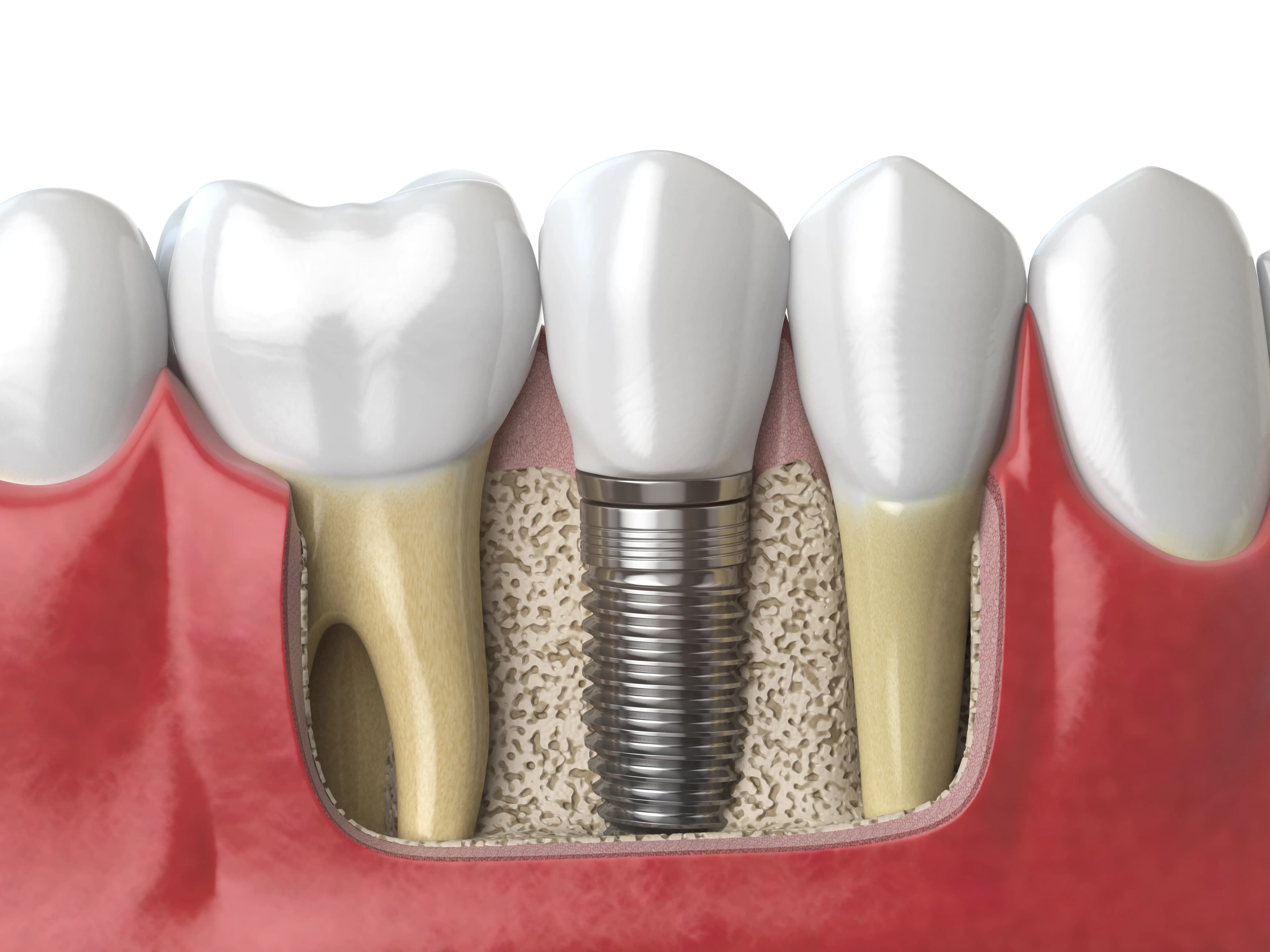 Implantes dentales