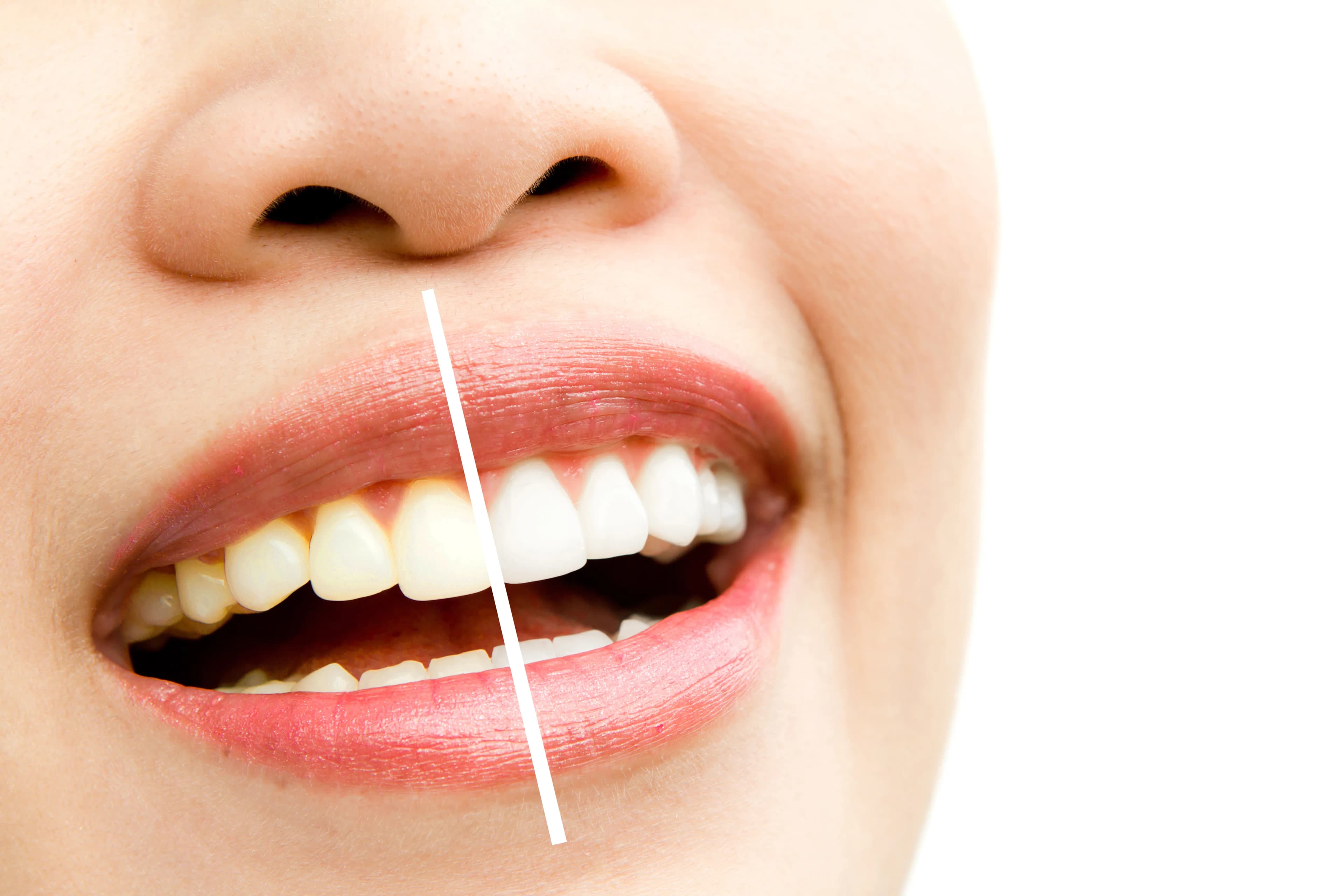 Blanqueamiento dental