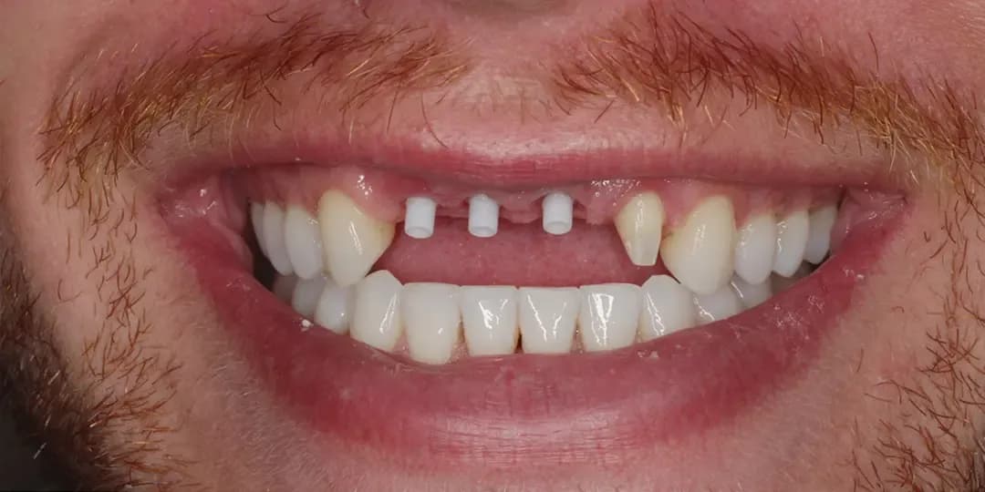Diseño de Sonrisa - Antes