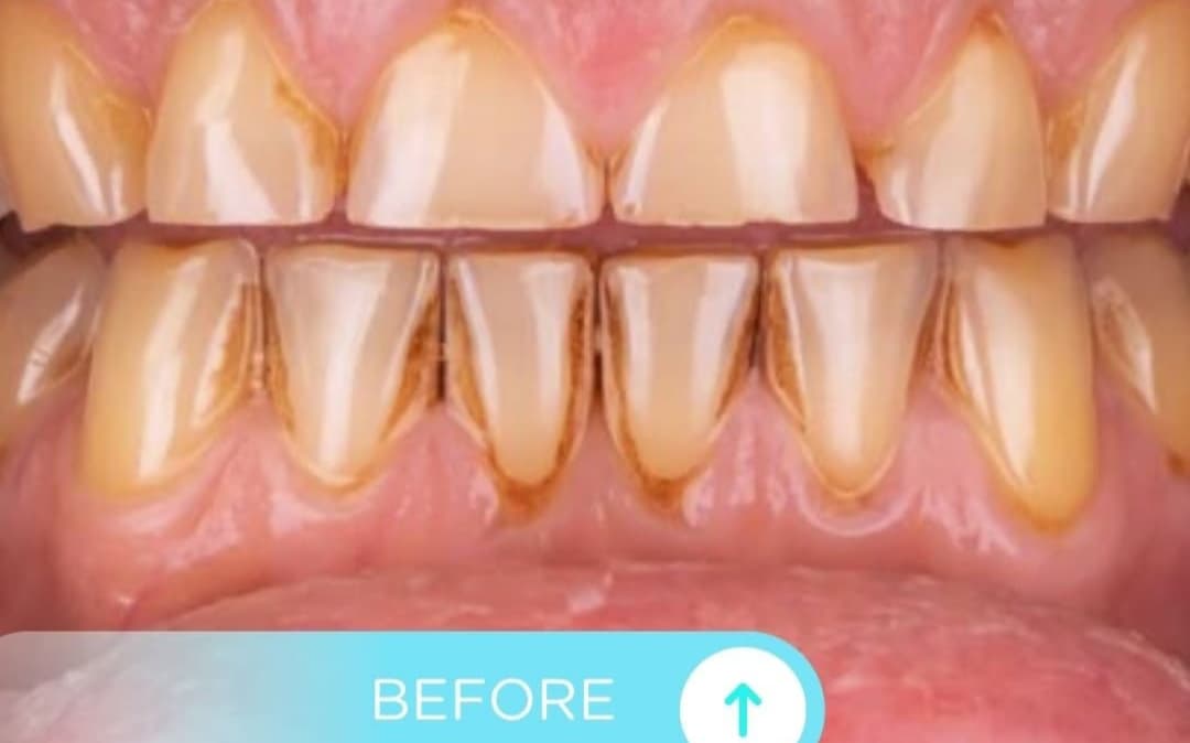 Before Ceramic veneers