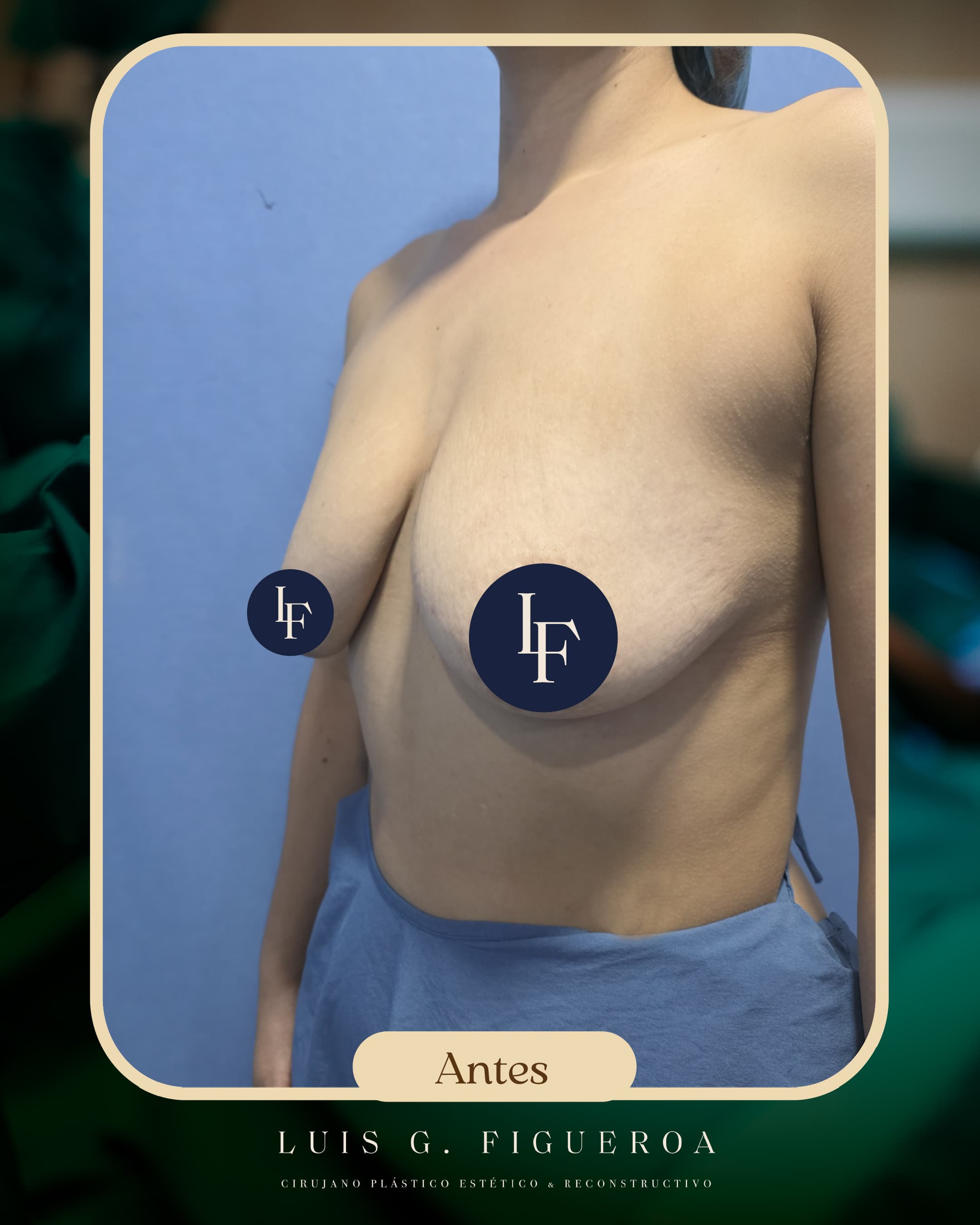 Before Mastopexy with implants