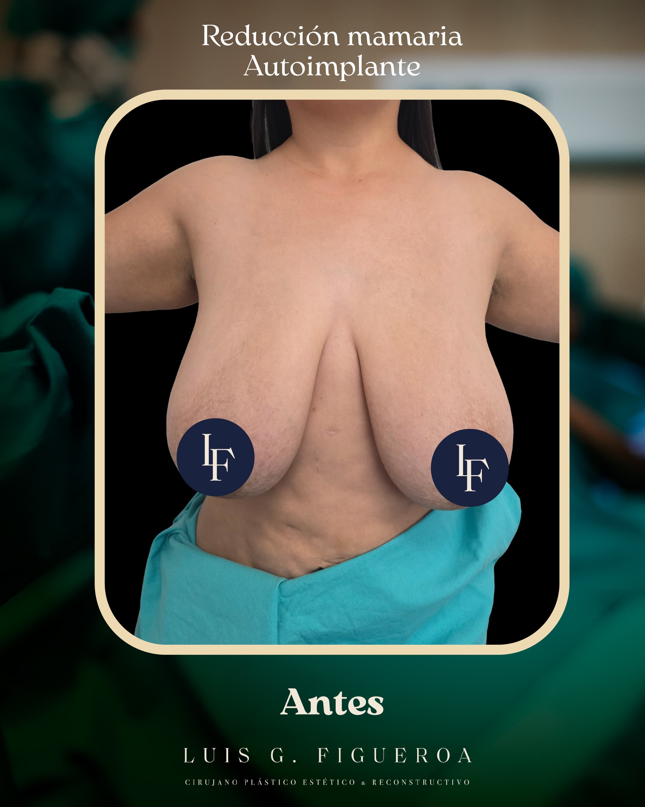 Before Breast reduction with autologous implant