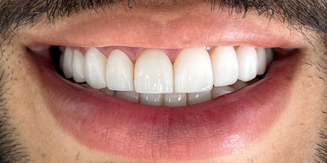 Before Ceramic Veneers
