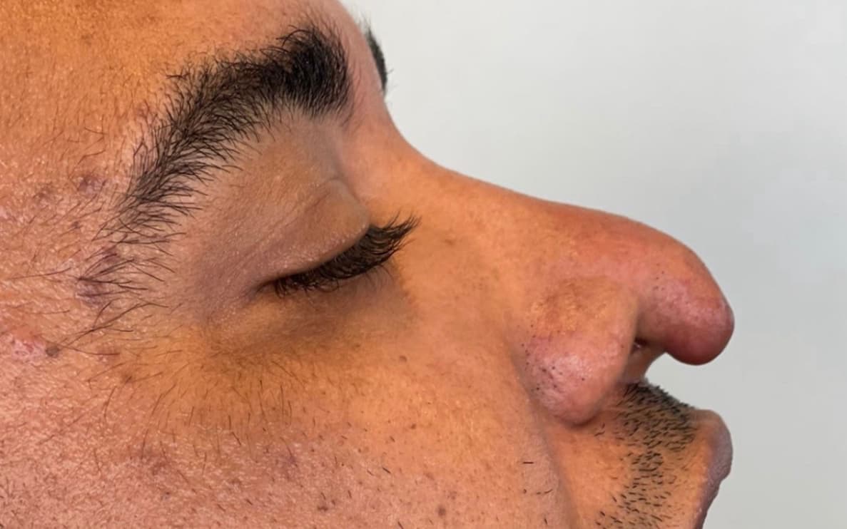 Before Rhinoplasty reconstruction of the nasal tip