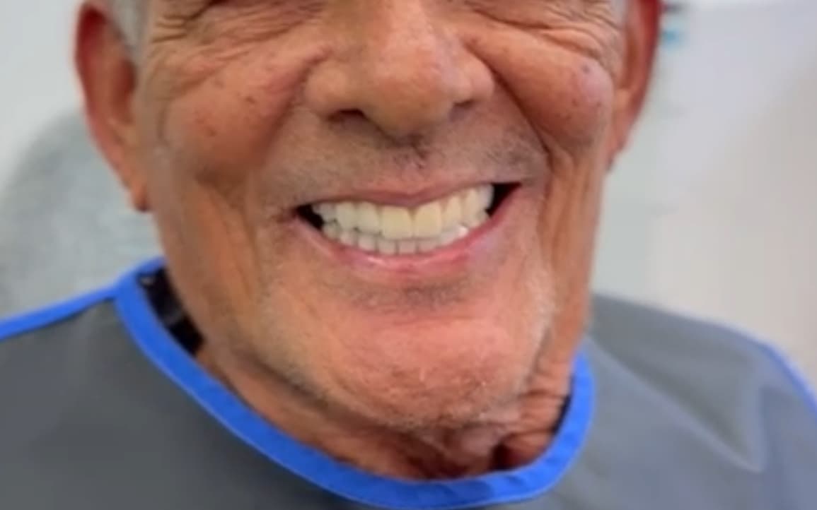 After Dental implants