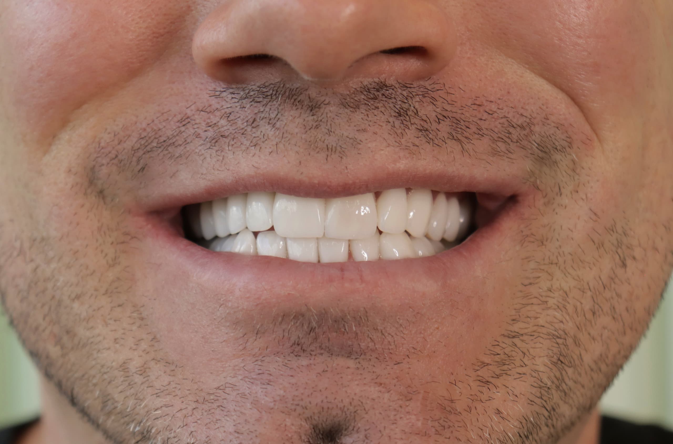 After Natural Ceramic Lenses