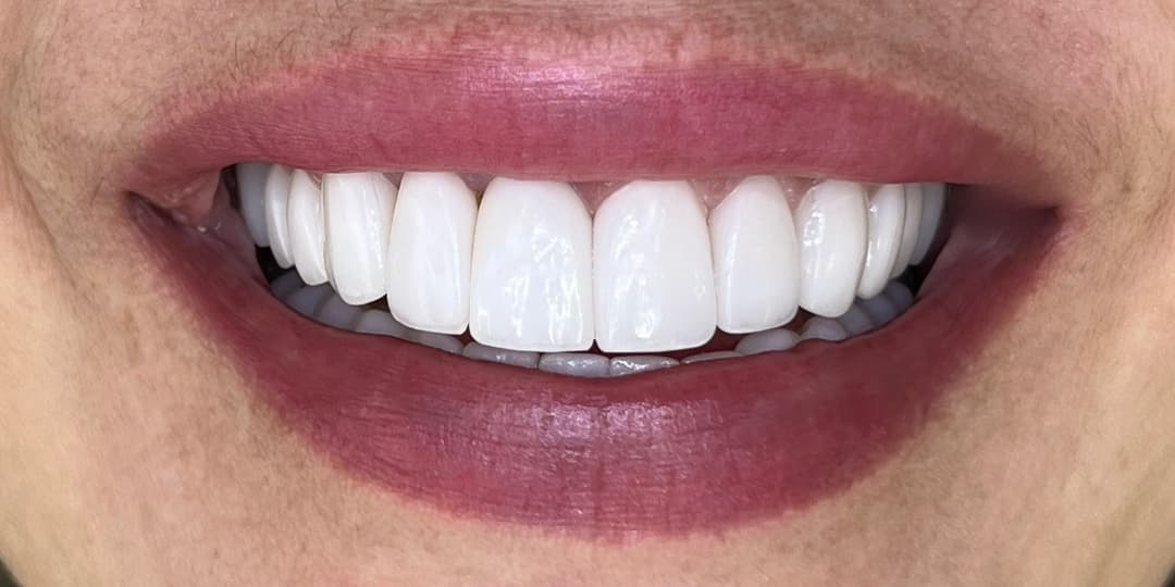 After Smile Design Renewal