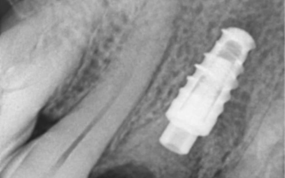 Before Immediate implant post-extraction