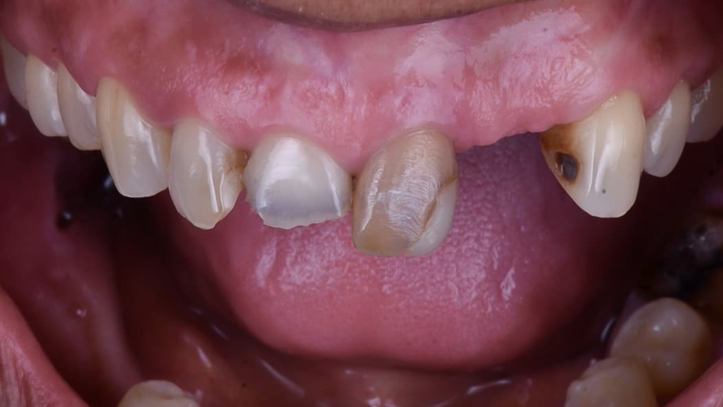 Before Zirconia crowns with ceramic layering