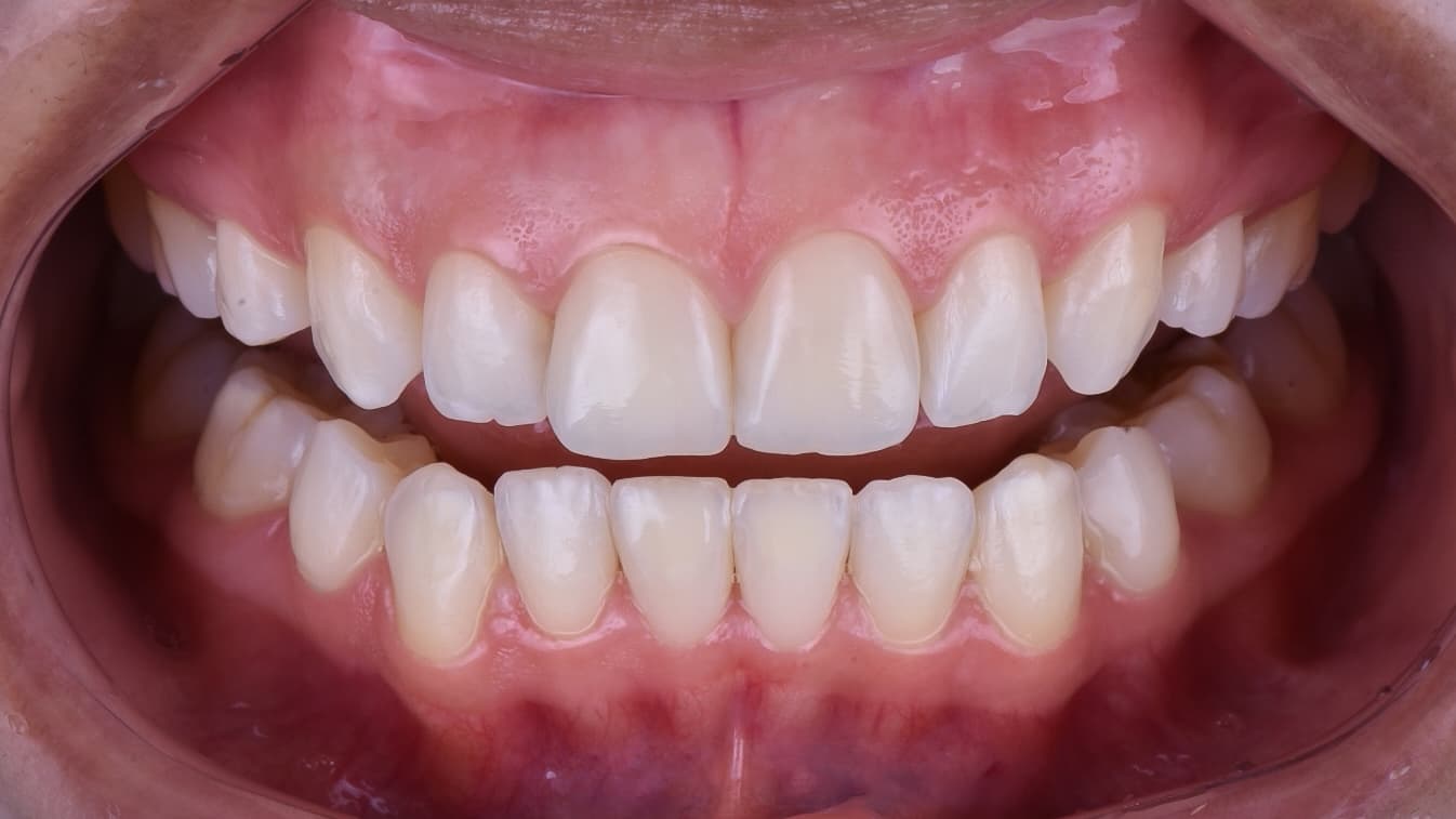 After Composite resin veneer plus whitening