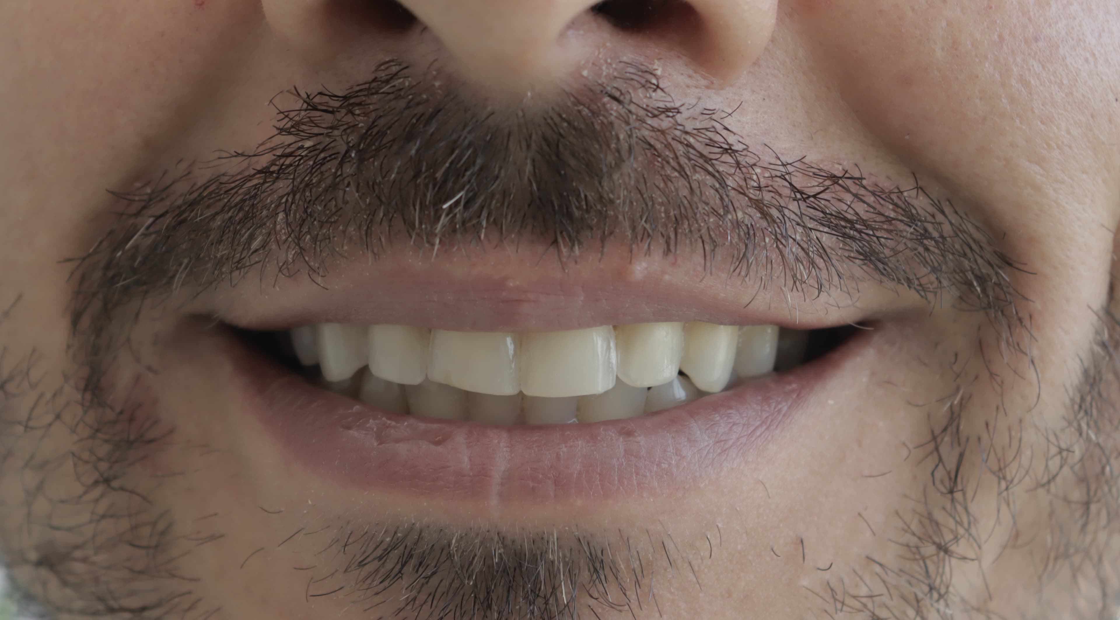 Before Natural Ceramic Lenses