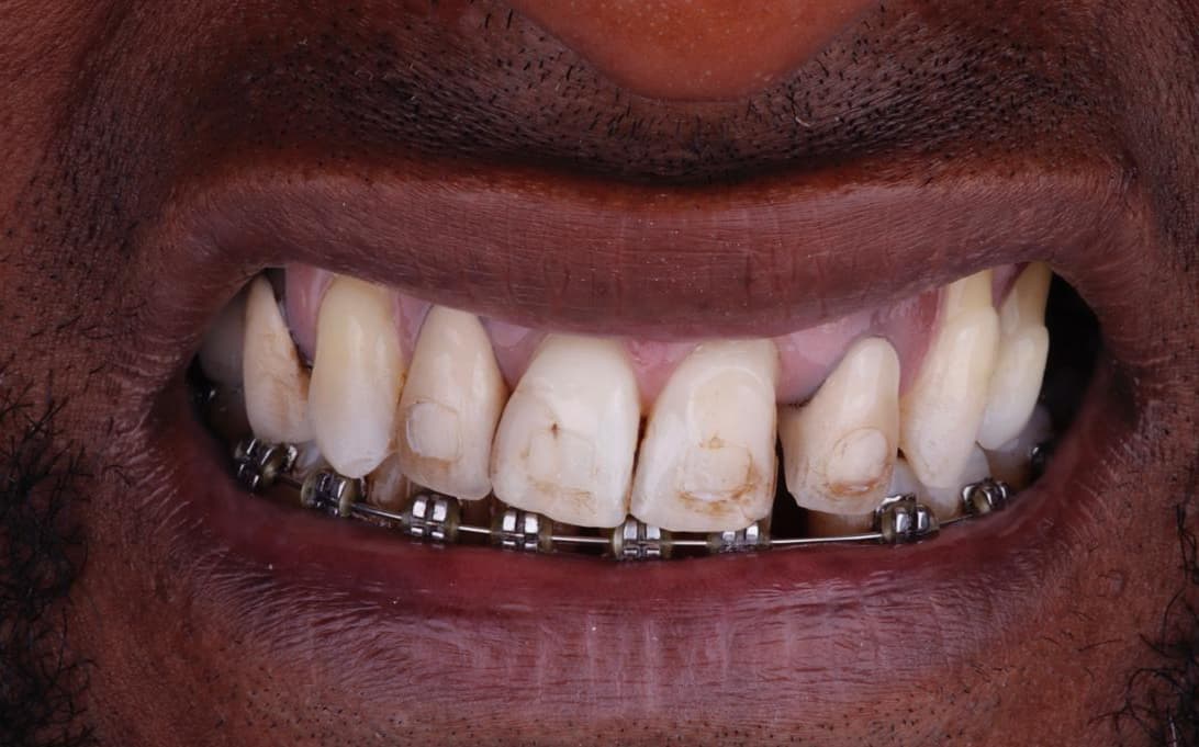 Before Aesthetic Ceramic Veneers