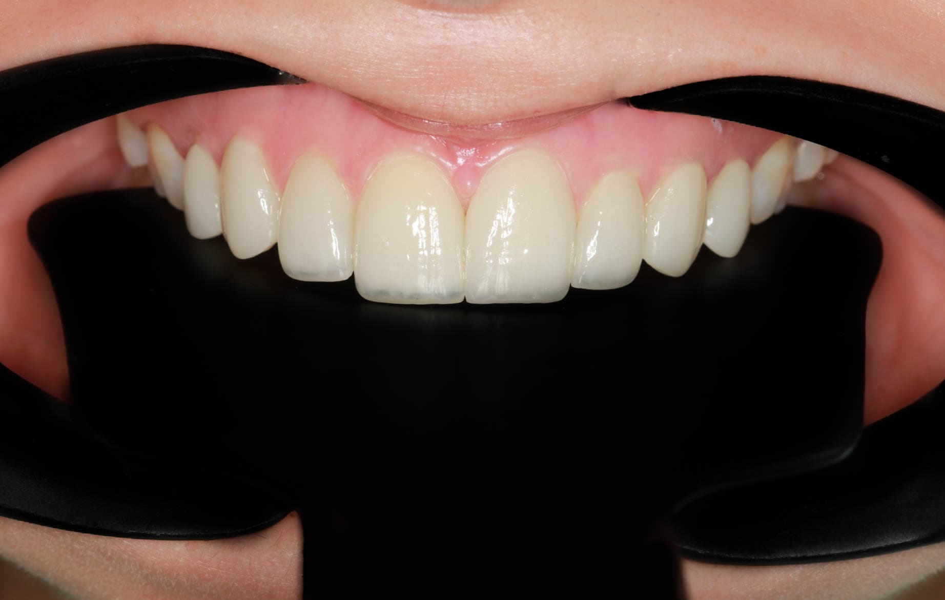 After Natural Ceramic Lenses
