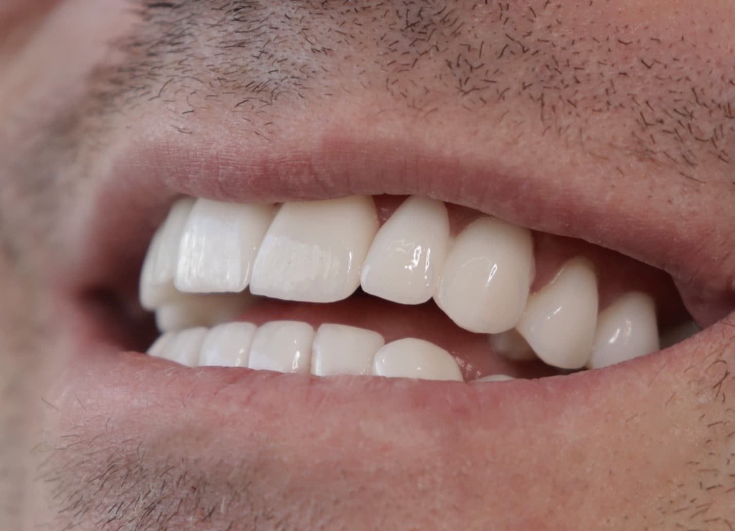 After Natural Ceramic Lenses