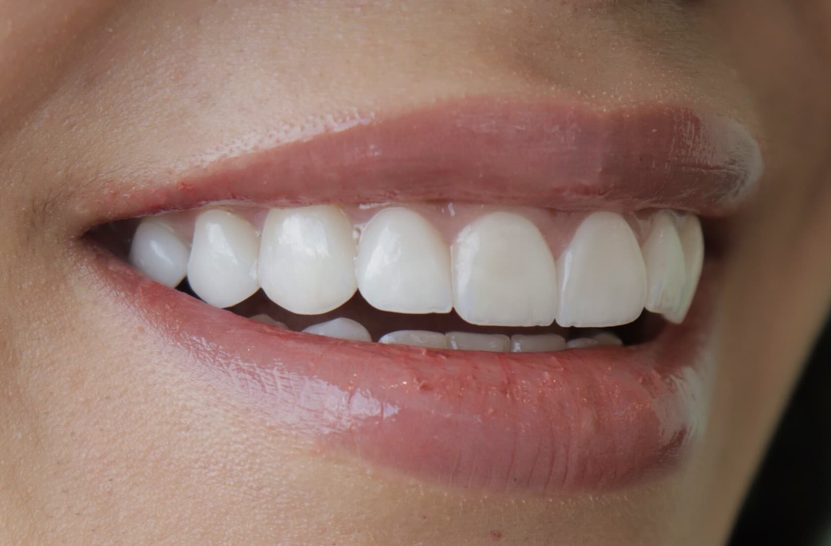 After Natural ceramic lenses