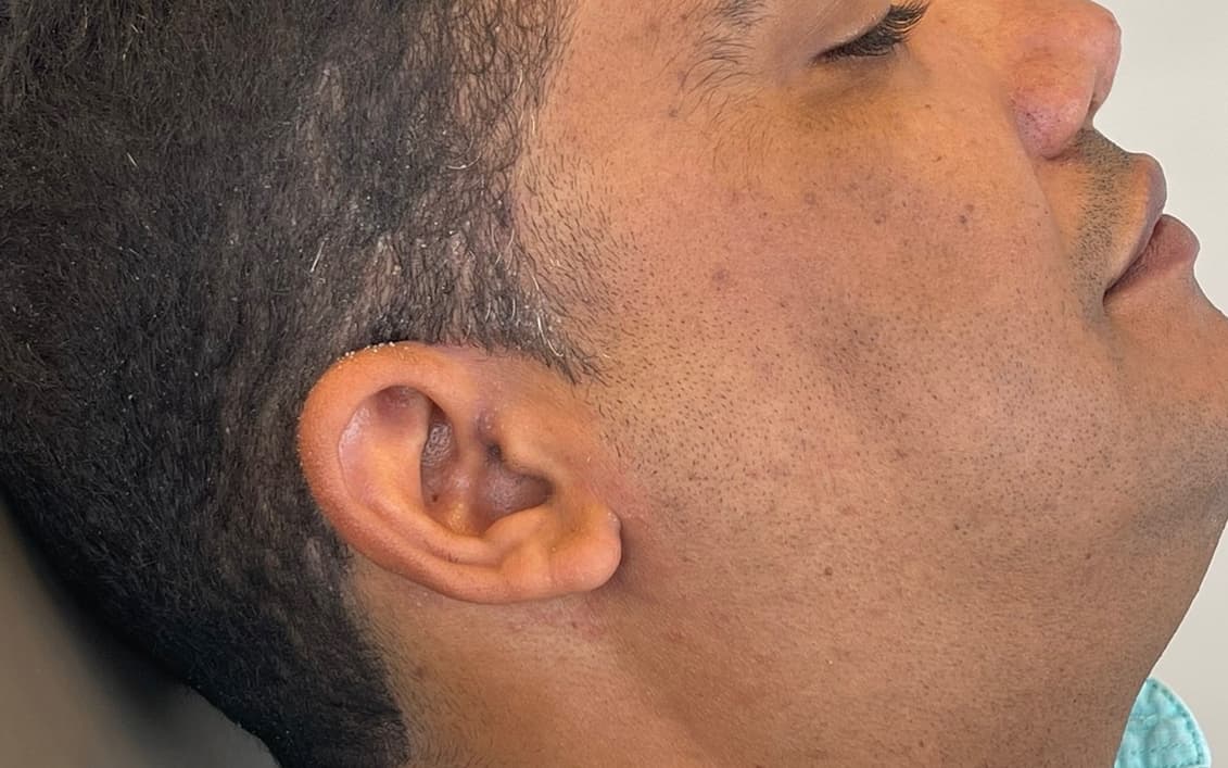 After Rhinoplasty reconstruction of the nasal tip