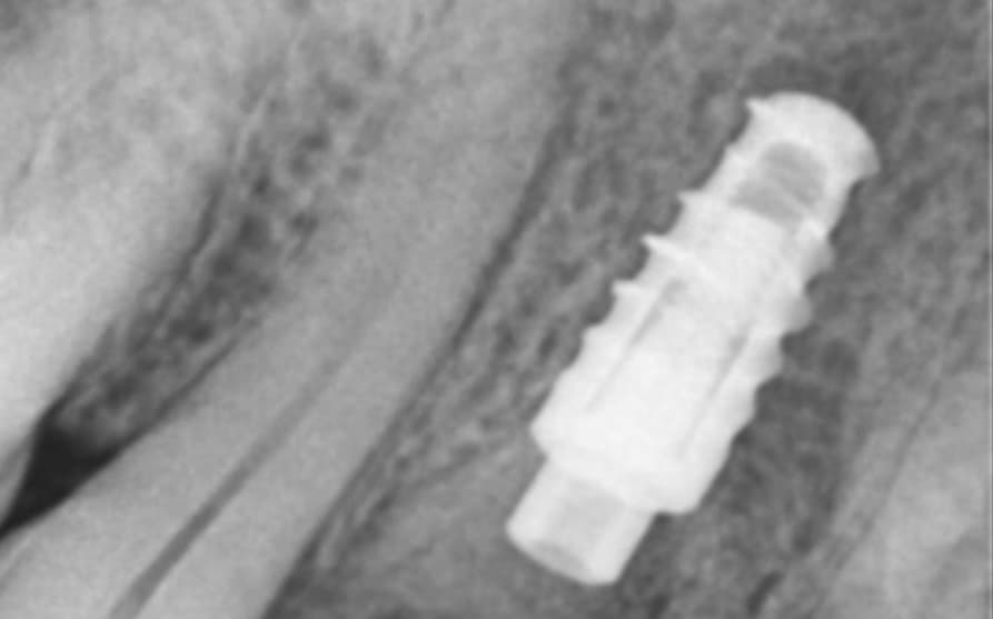 After Immediate implant post-extraction