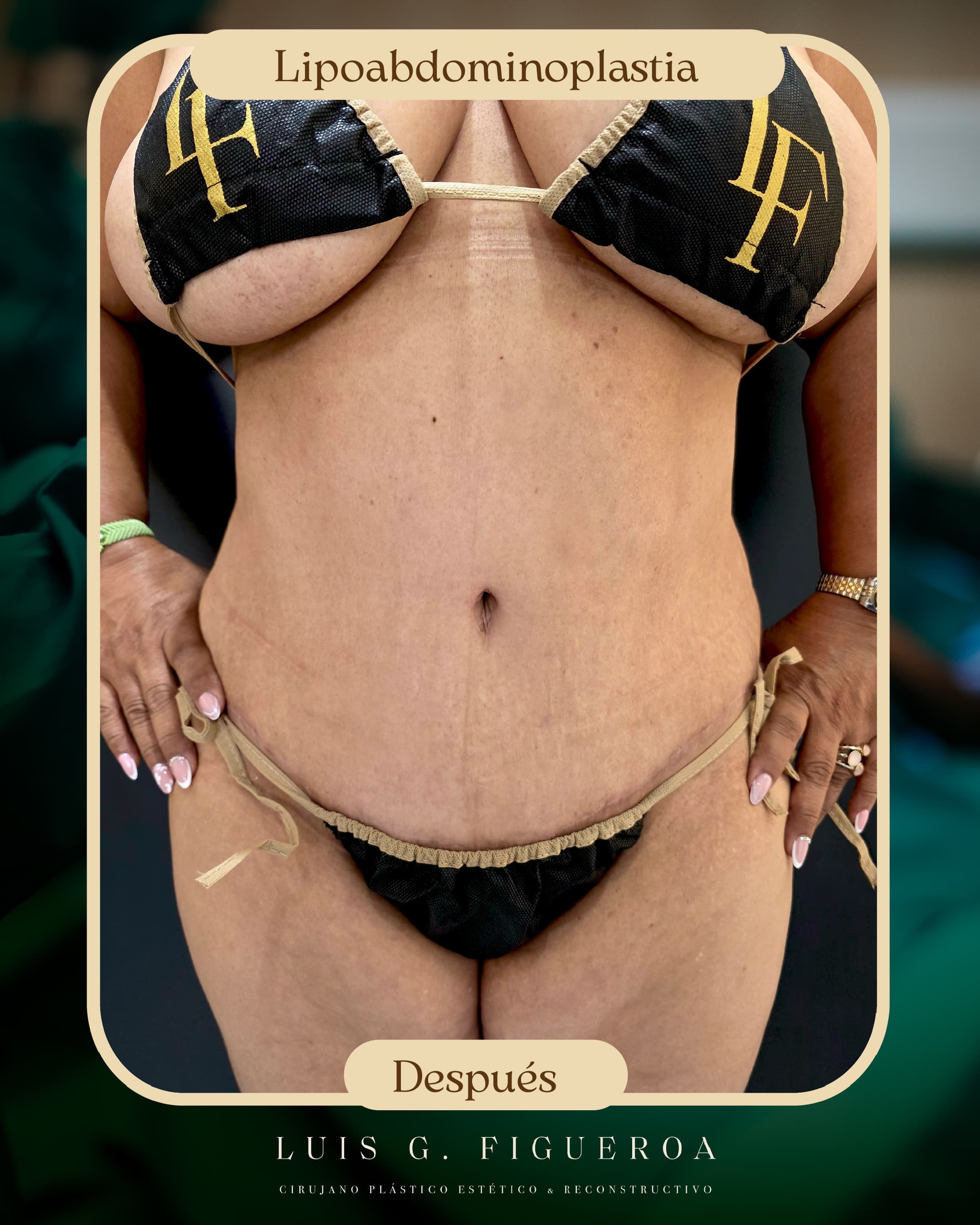 After Lipoabdominoplasty