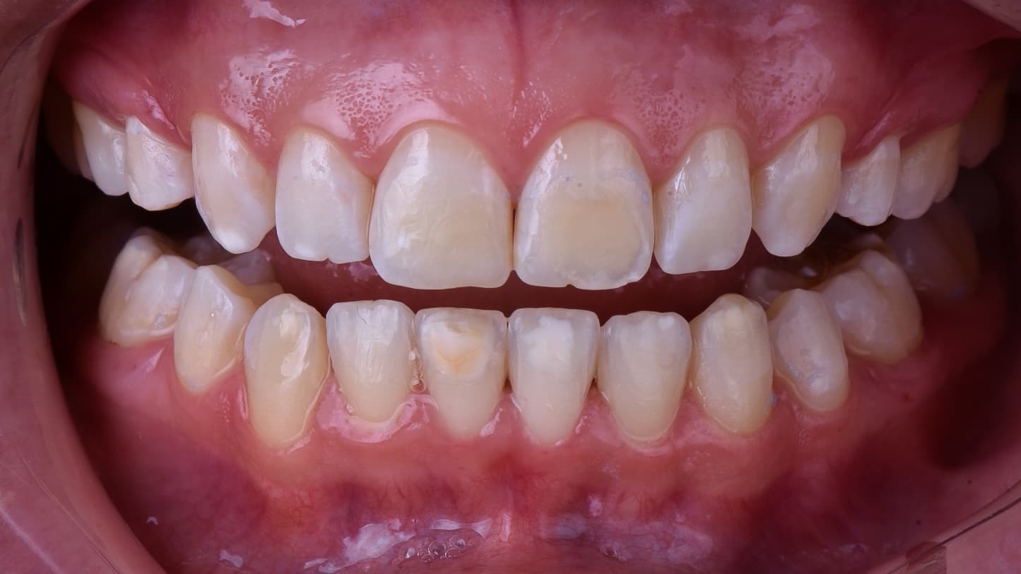 Before Composite resin veneer plus whitening