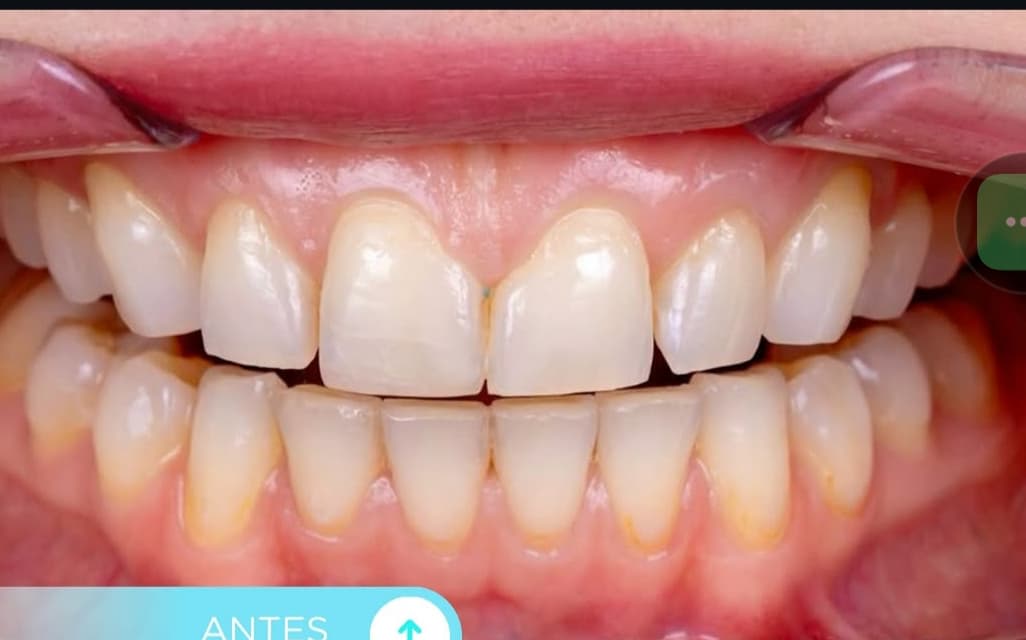 Before Smile design