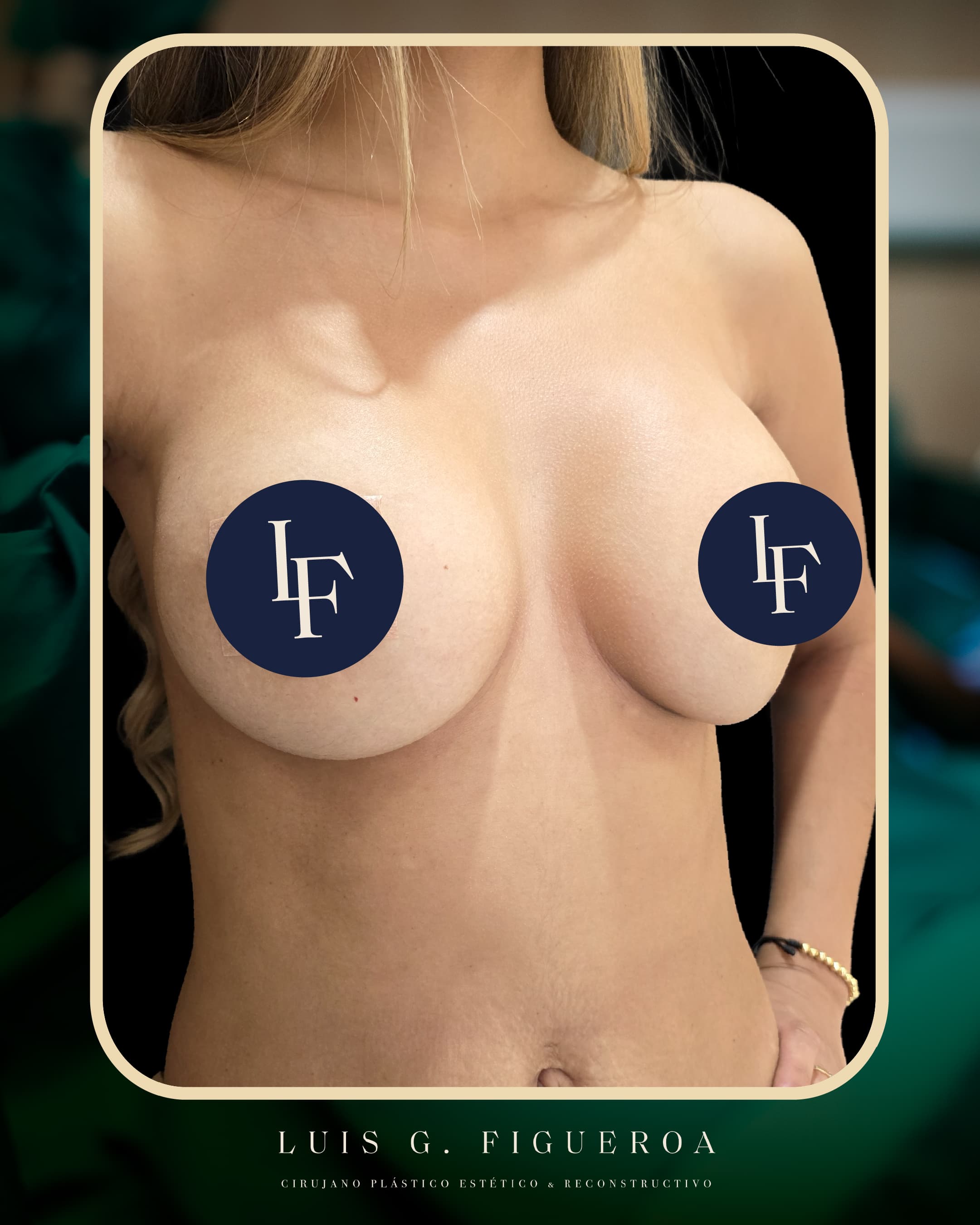 After Implant replacement