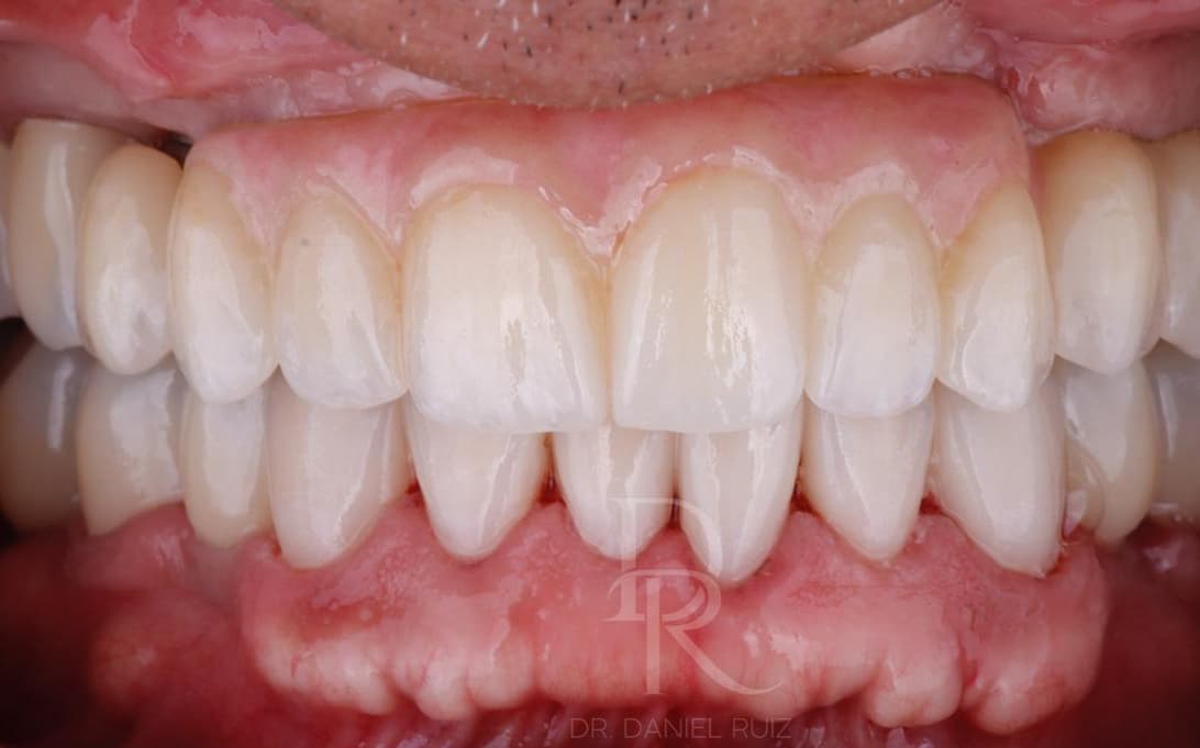 After Complete Ceramic Rehabilitation