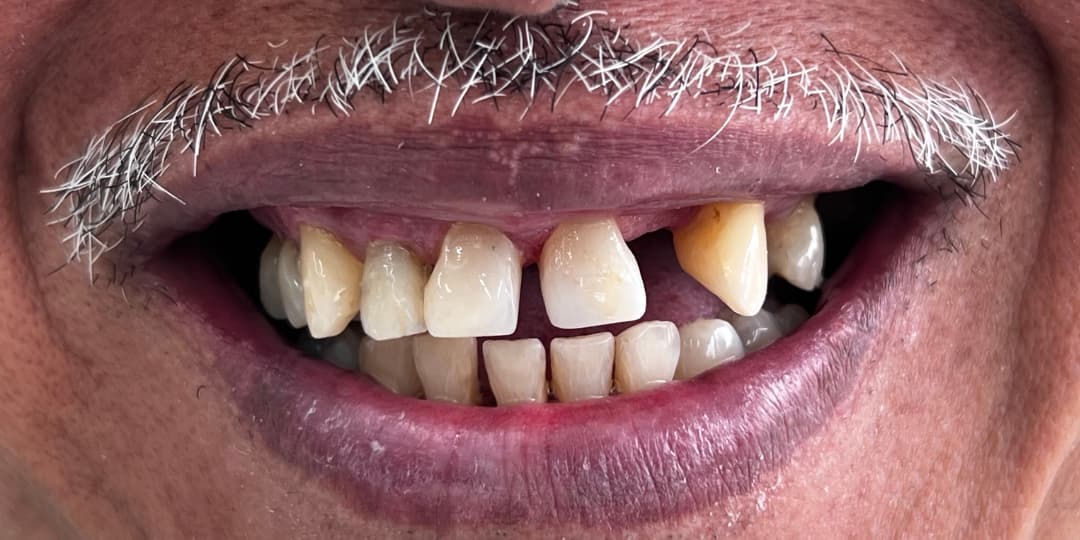 Before Rehabilitation + Ceramic Veneers