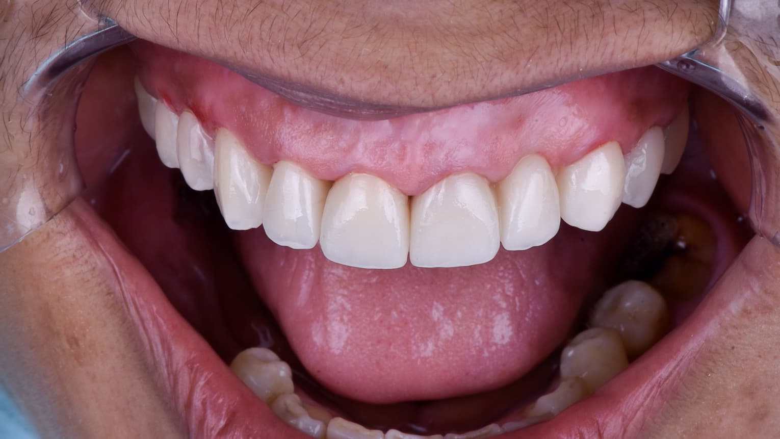 After Zirconia crowns with ceramic layering