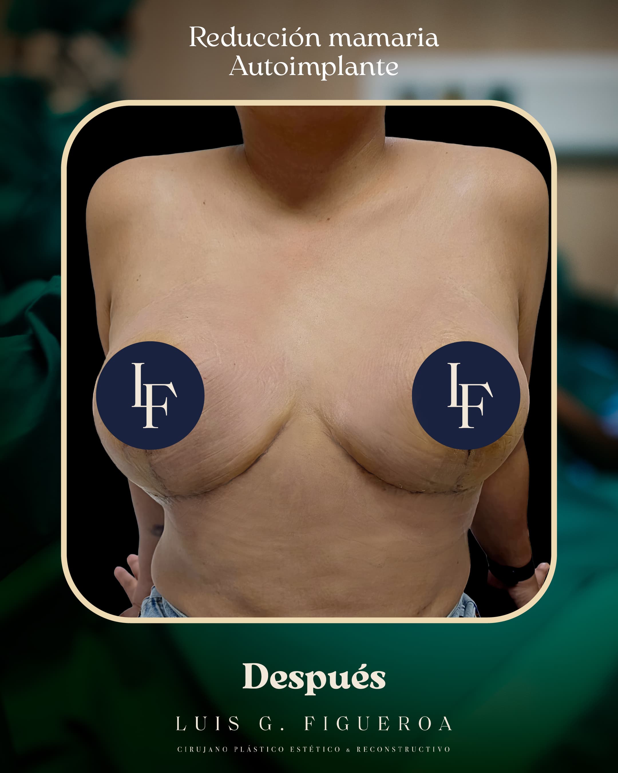 After Breast reduction with autologous implant