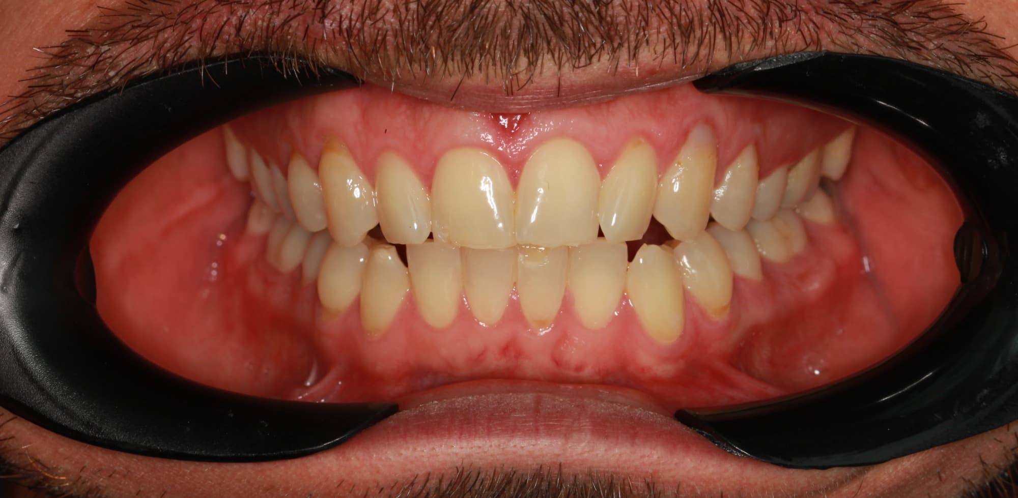 Before Ceramic Lenses
