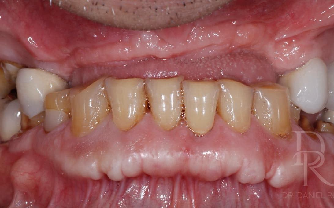 Before Complete Ceramic Rehabilitation