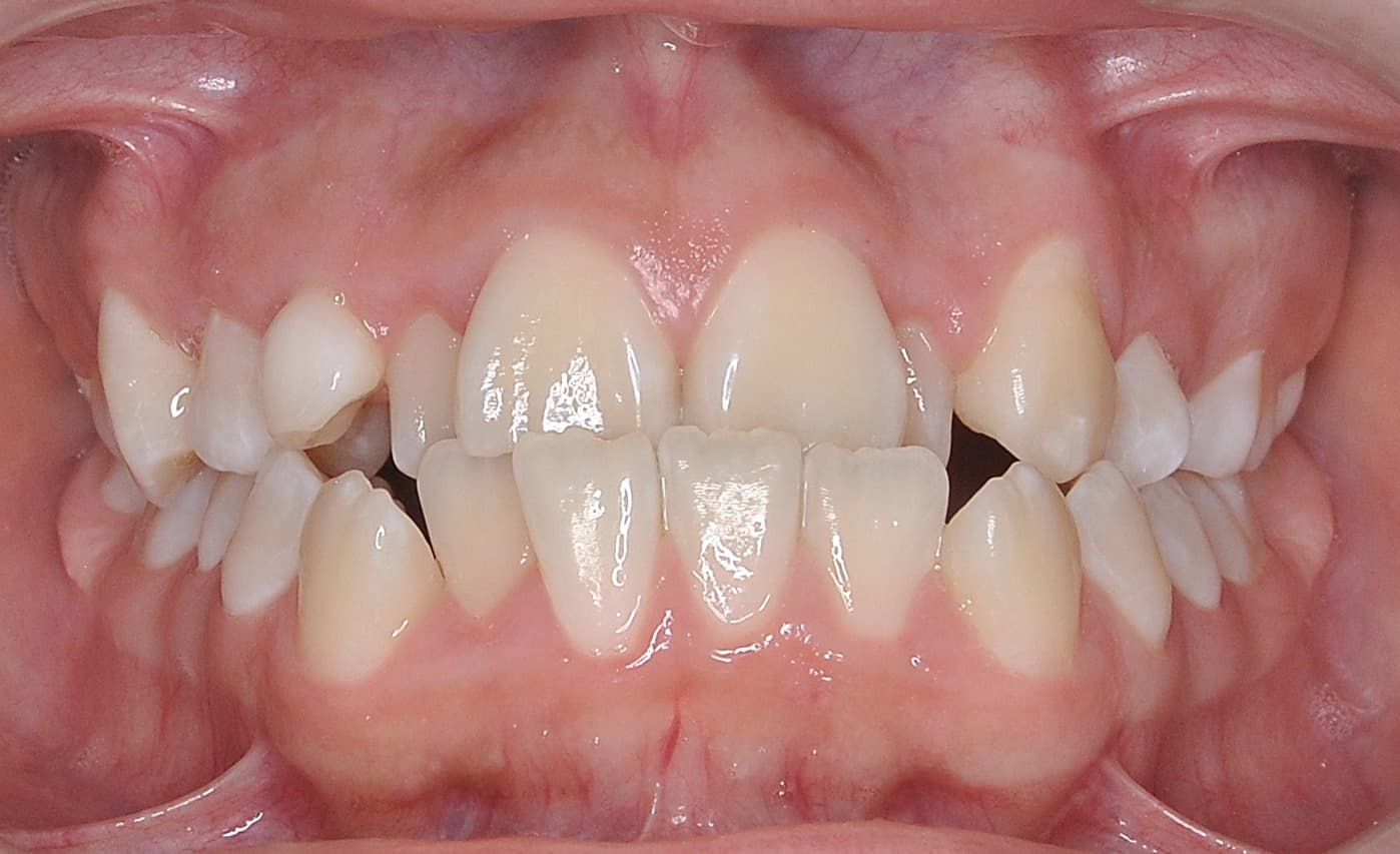 Before Self-Ligating Orthodontics