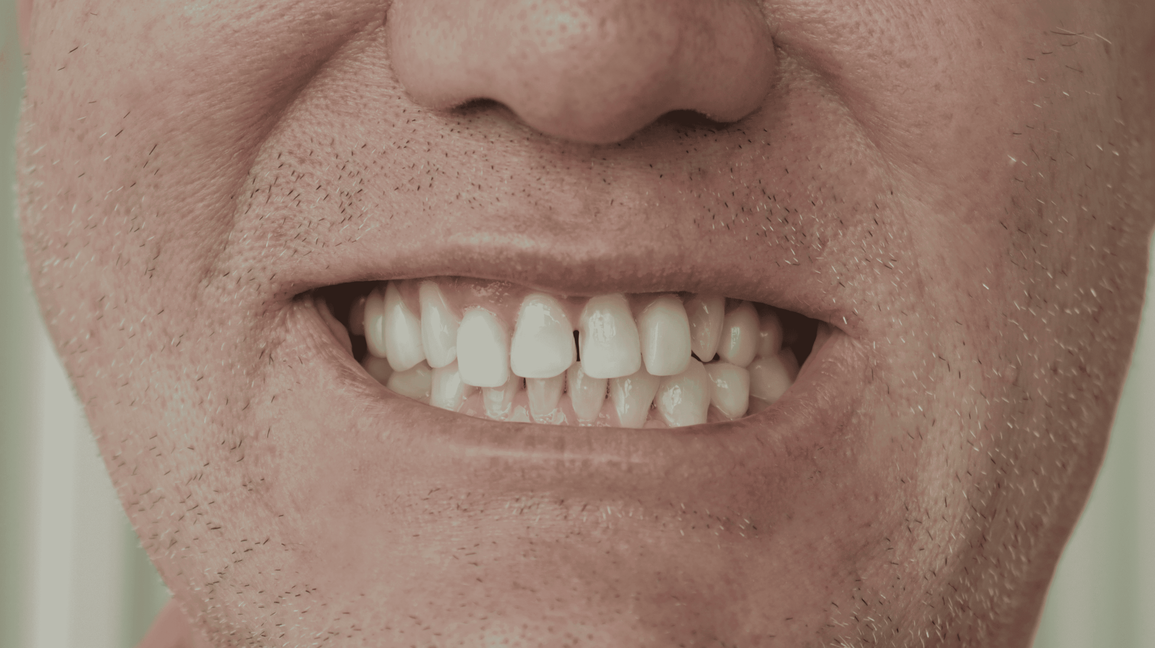 Before Natural Ceramic Lenses