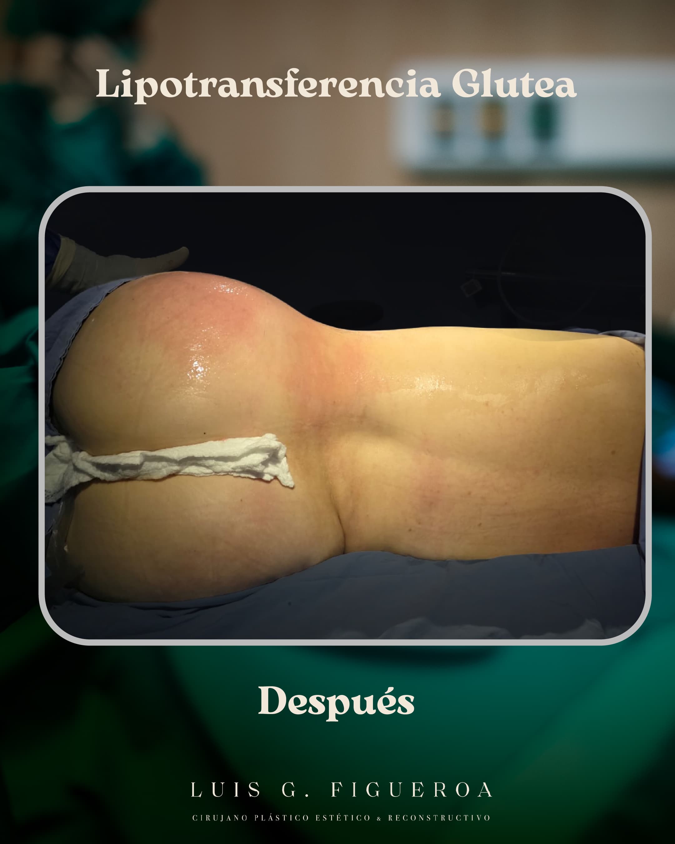 After Lipotransfer