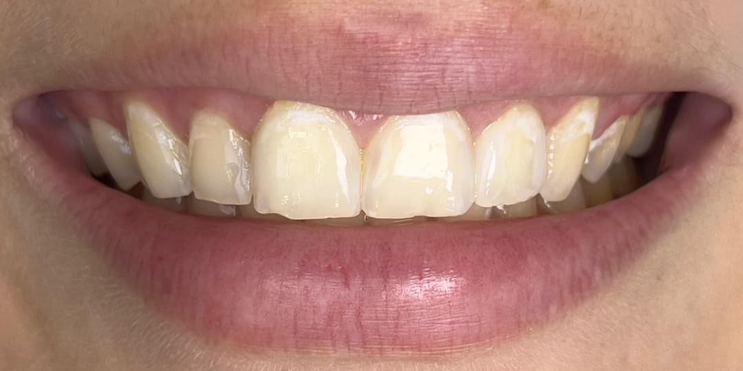 Before Porcelain Veneers