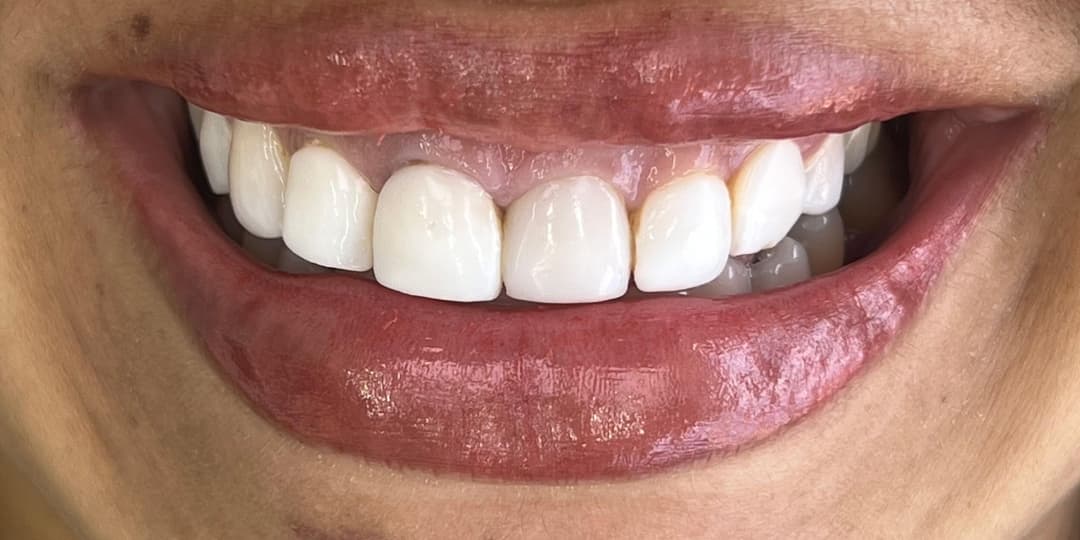 Before Ceramic Veneers and Lip Contouring