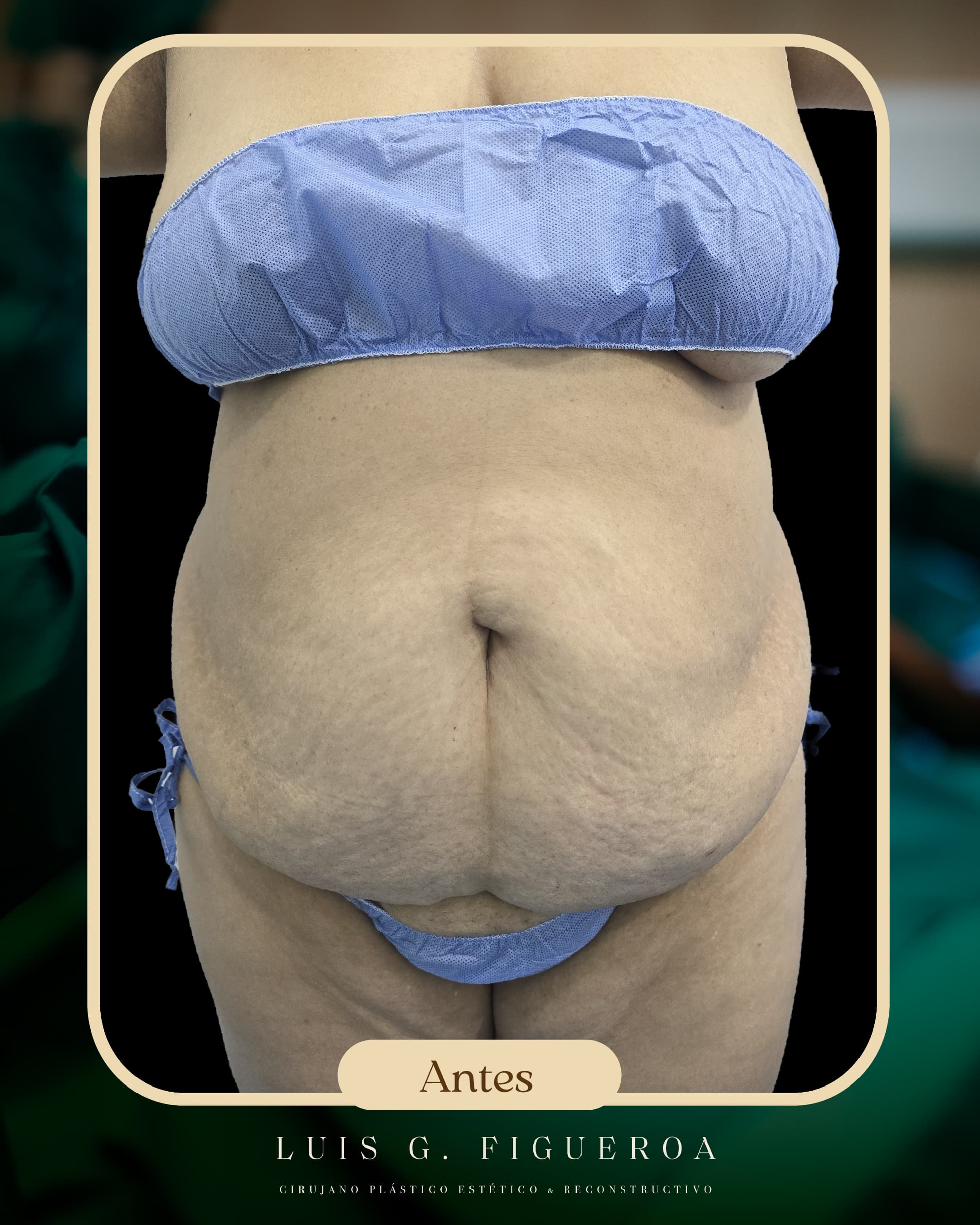 Before Lipoabdominoplasty
