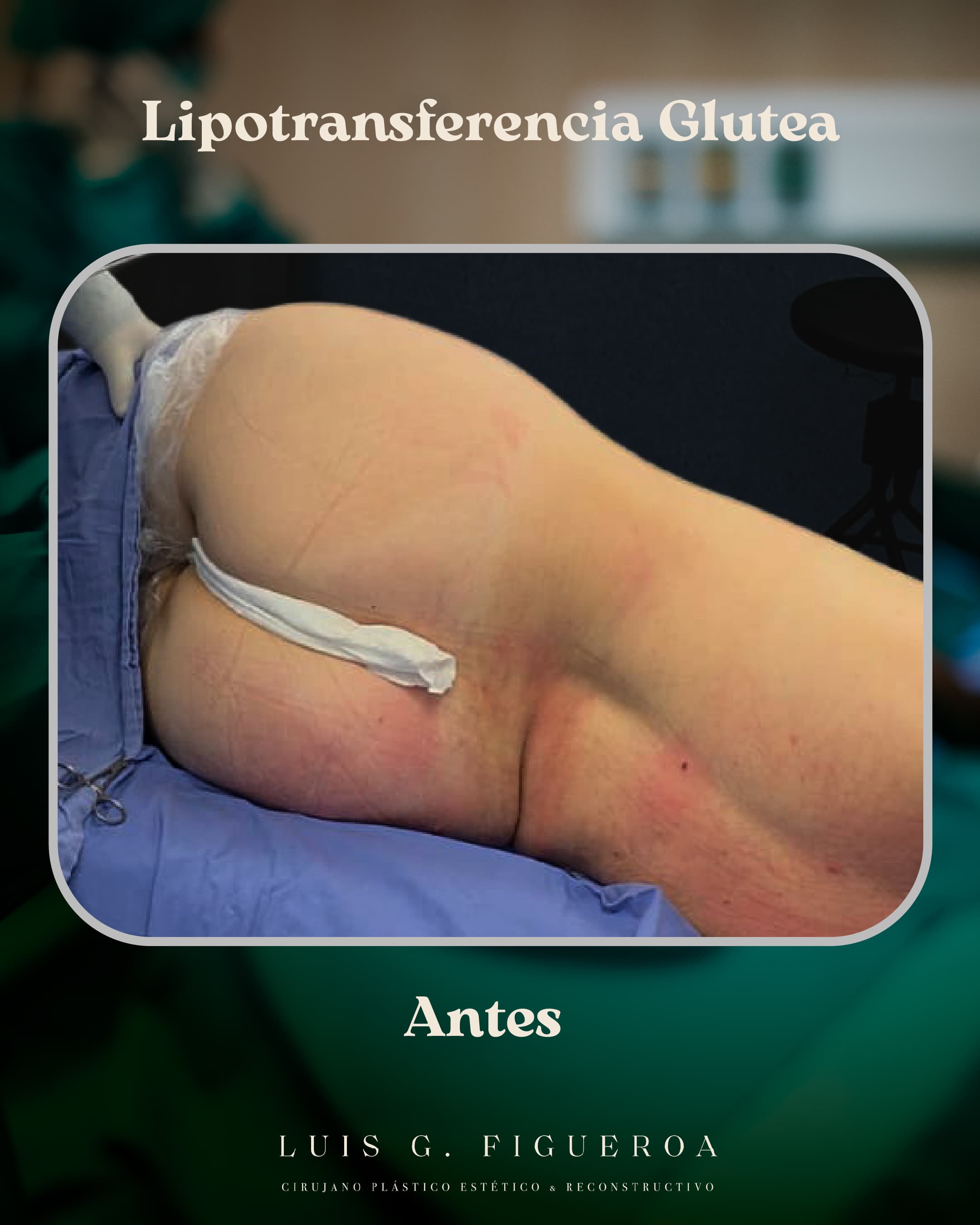Before Lipotransfer