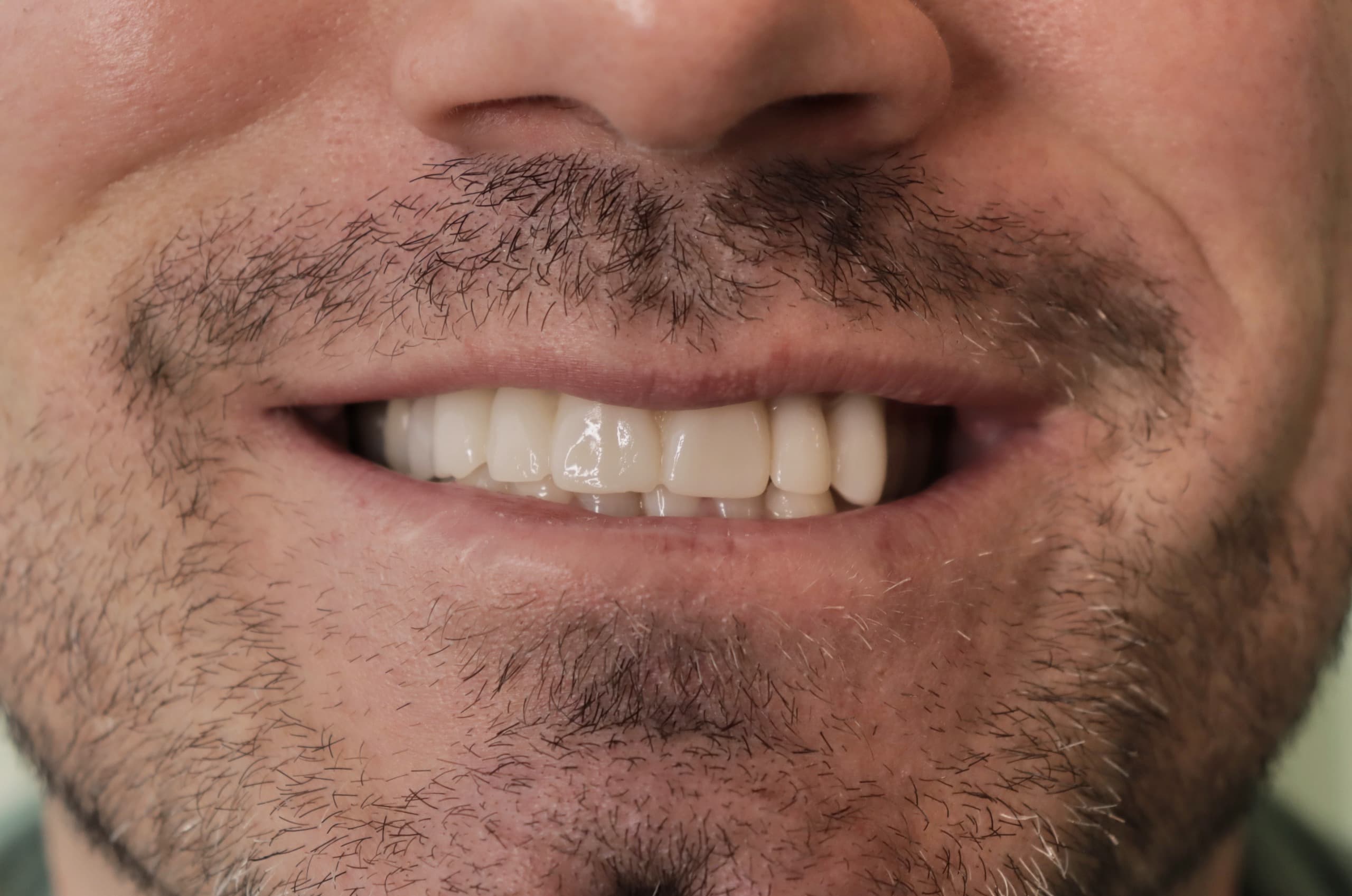Before Natural Ceramic Lenses