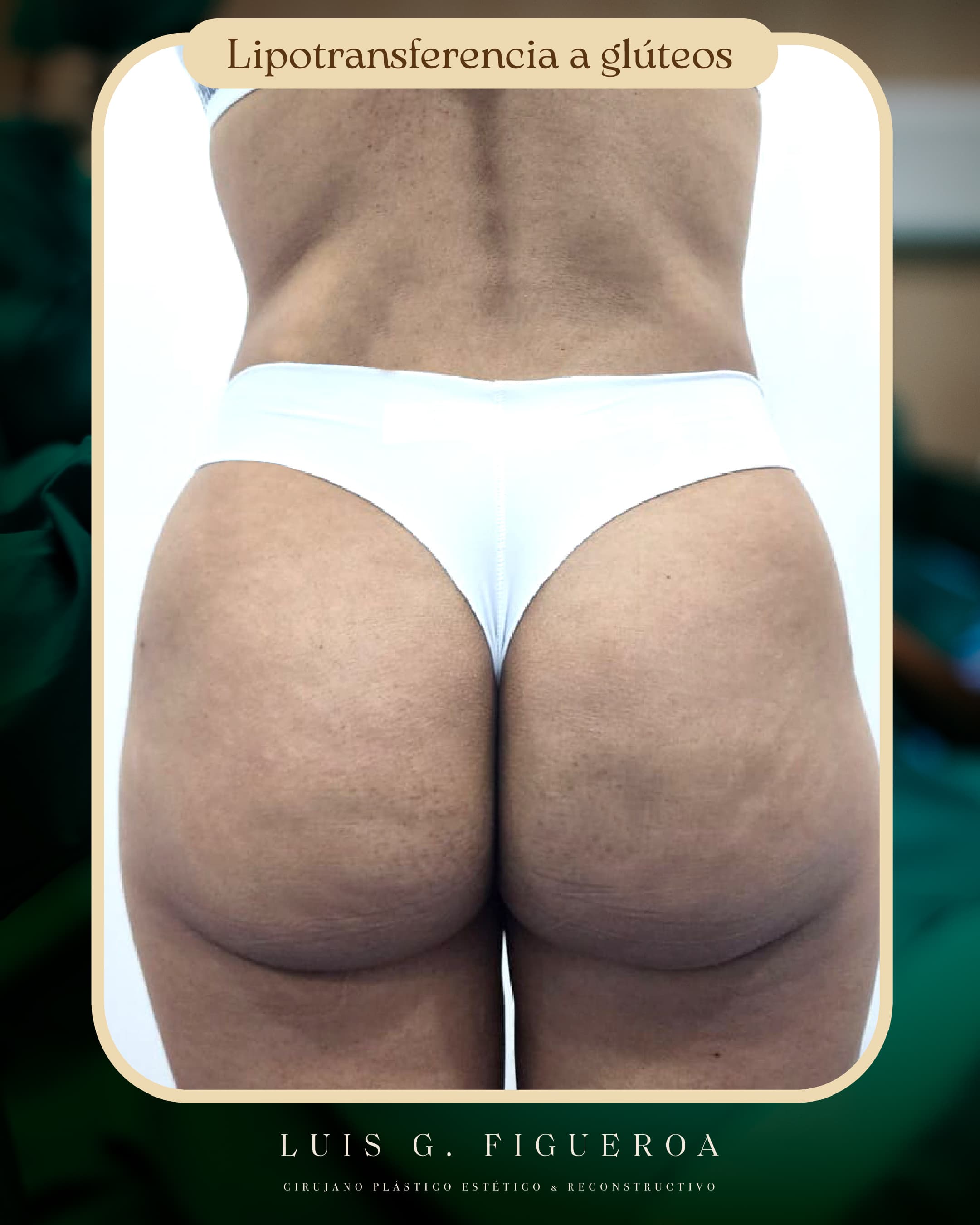 After Lipotransfer