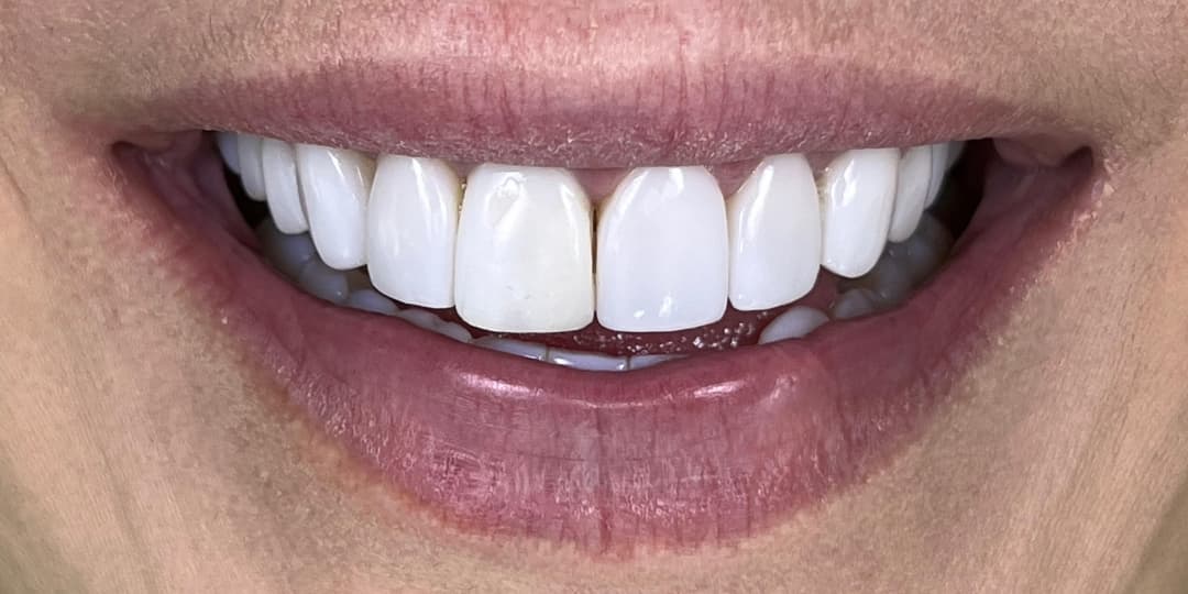 Before Smile Design Renewal