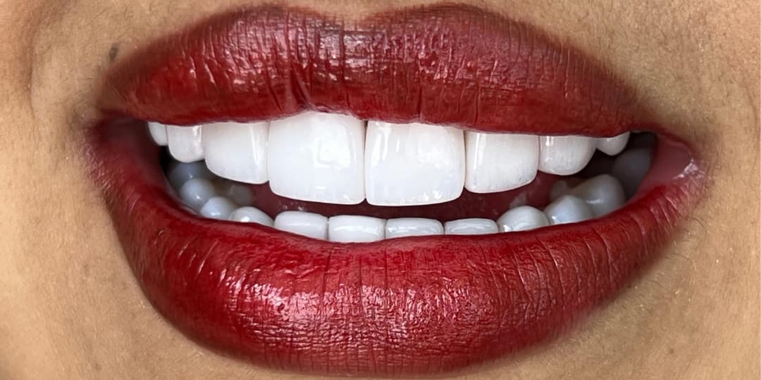 After Ceramic Veneers and Lip Contouring