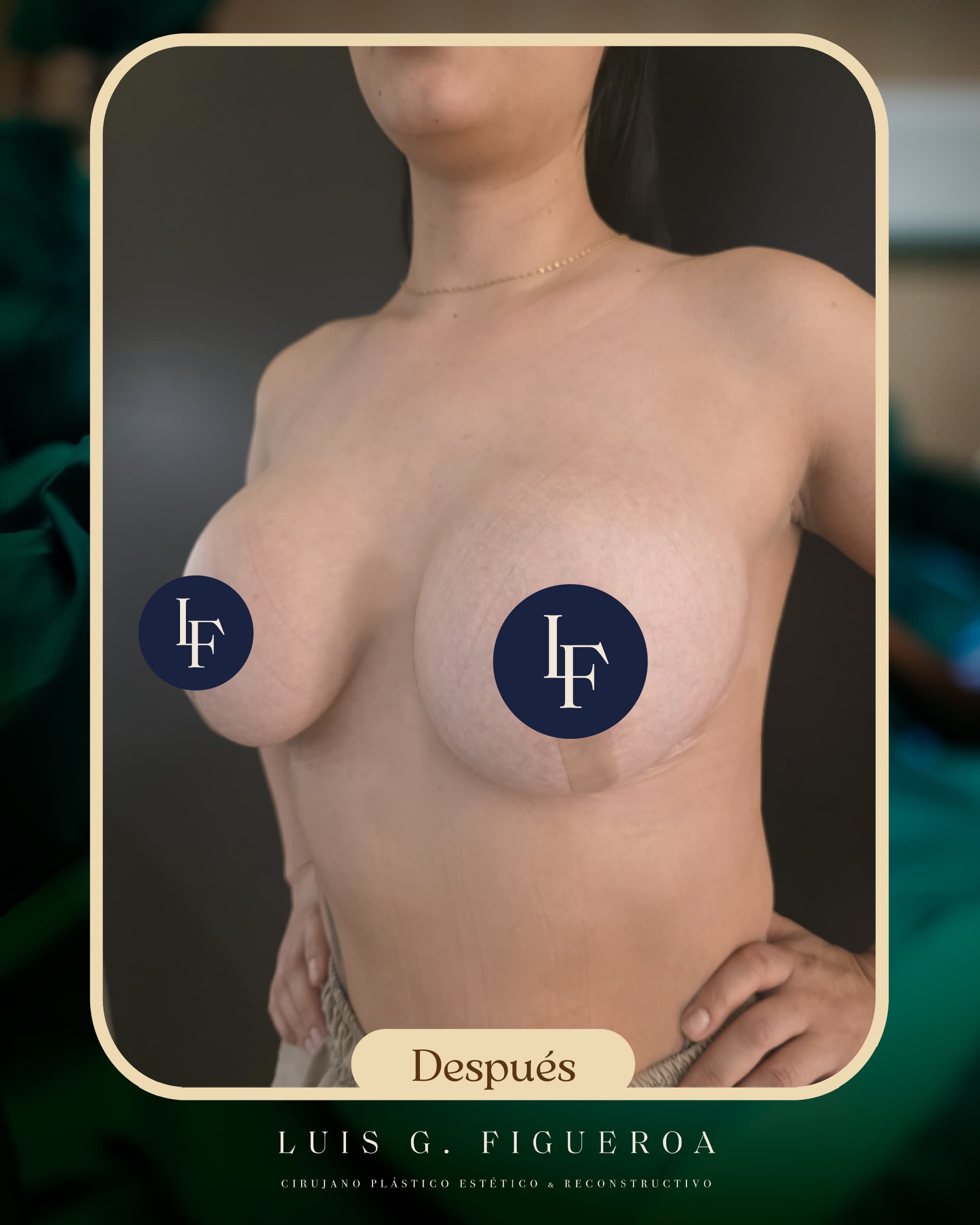 After Mastopexy with implants