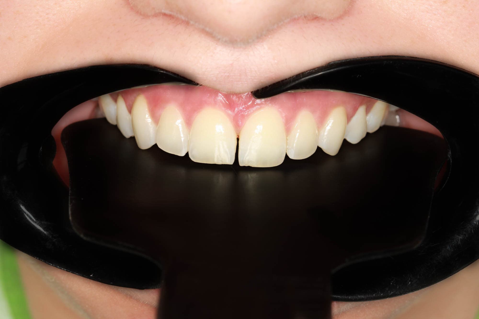 Before Natural Ceramic Lenses