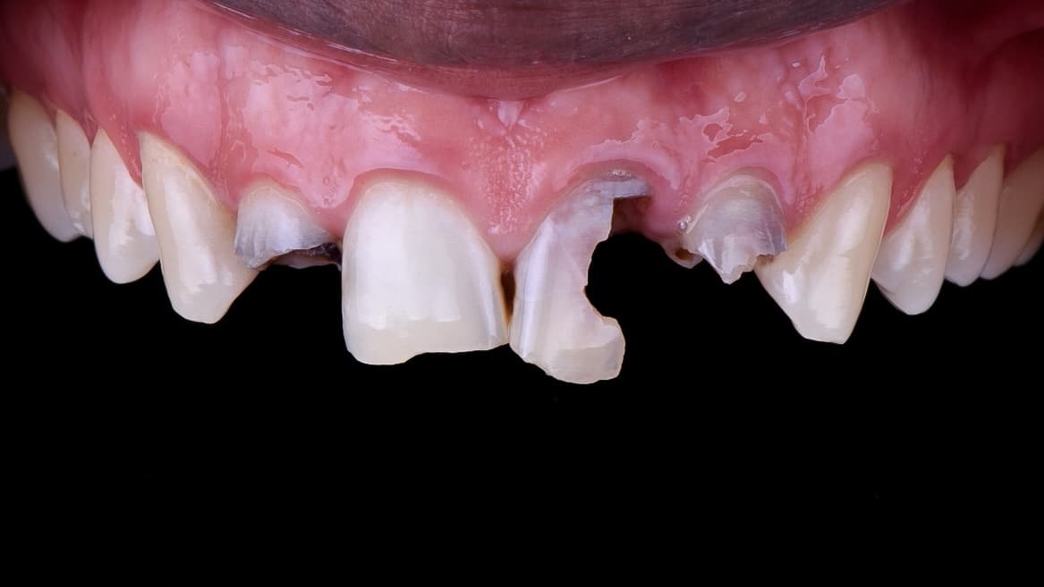 Before Composite resin veneer