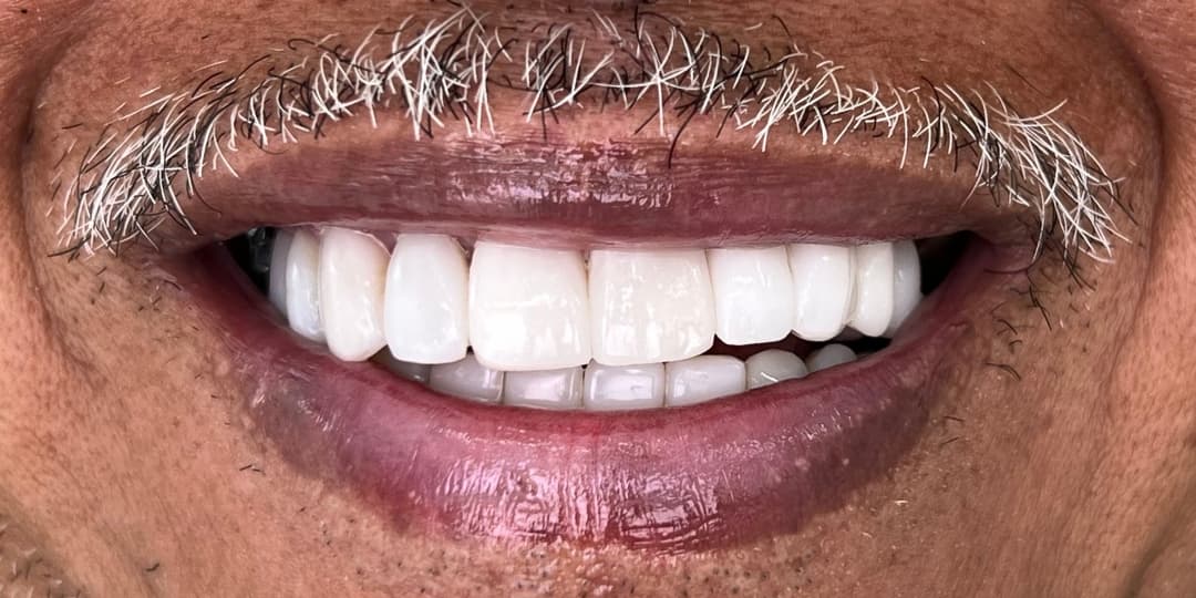 After Rehabilitation + Ceramic Veneers