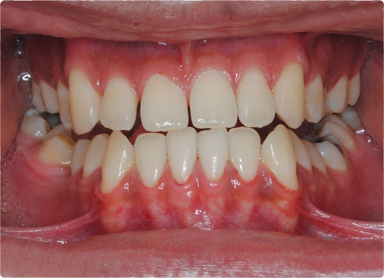 Before Self-Ligating Orthodontics