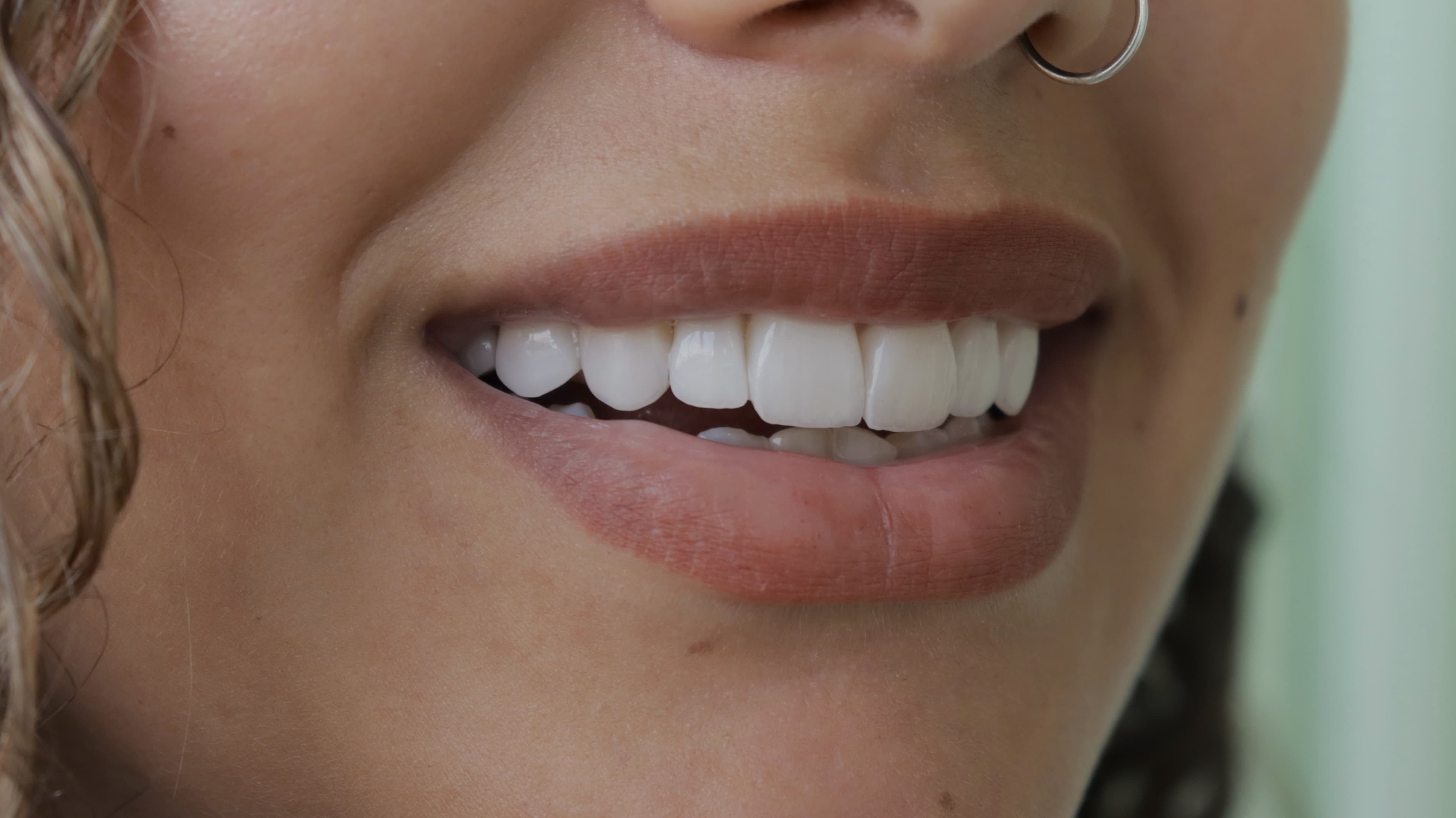 After Natural Ceramic Lenses
