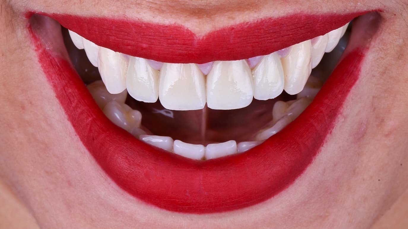 After Zirconia crowns with layered ceramic
