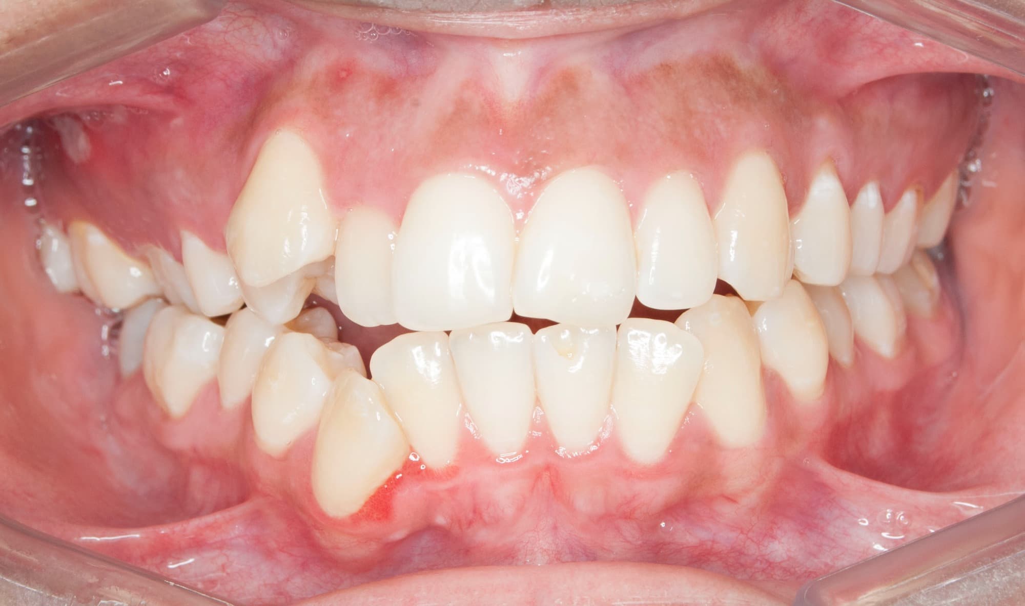 Before Self-Ligating Orthodontics
